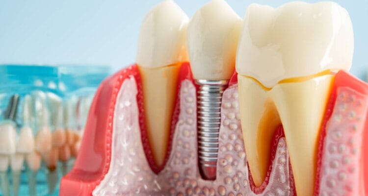 Implantologia dentara Art White Dental Clinic Ploiesti