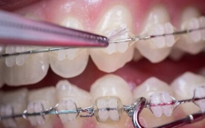 Aparat Dentar, tratamentul ortodontic la Art White Clinic Ploiesti