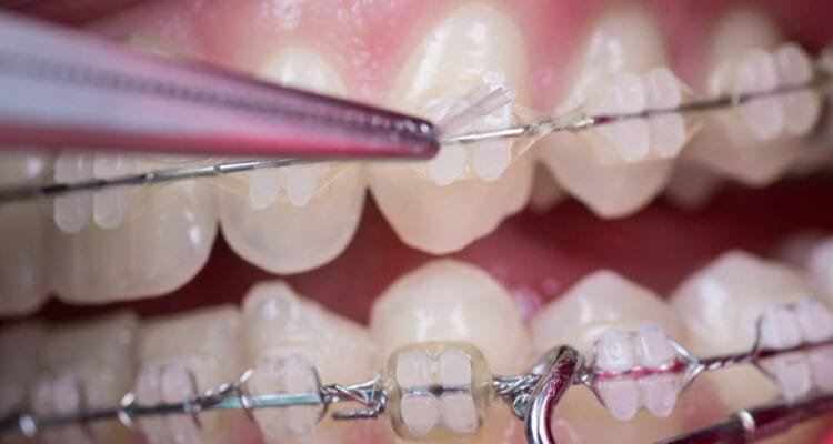 Aparat Dentar, tratamentul ortodontic la Art White Clinic Ploiesti